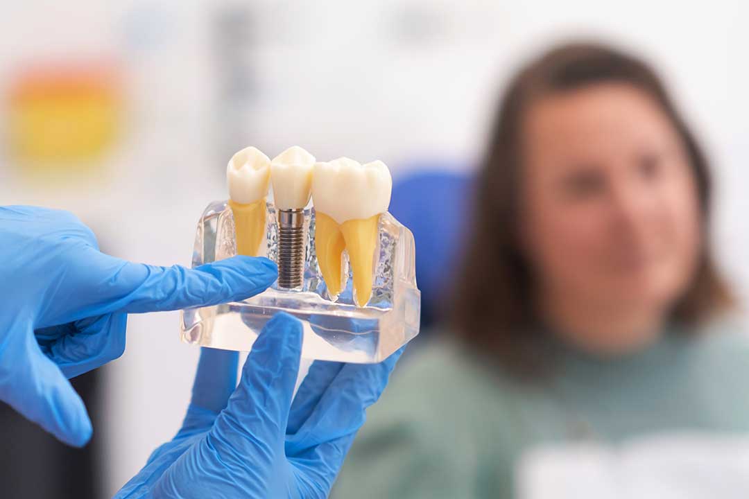 Dental Bridges vs. Dental Implants: Which is Right for You?