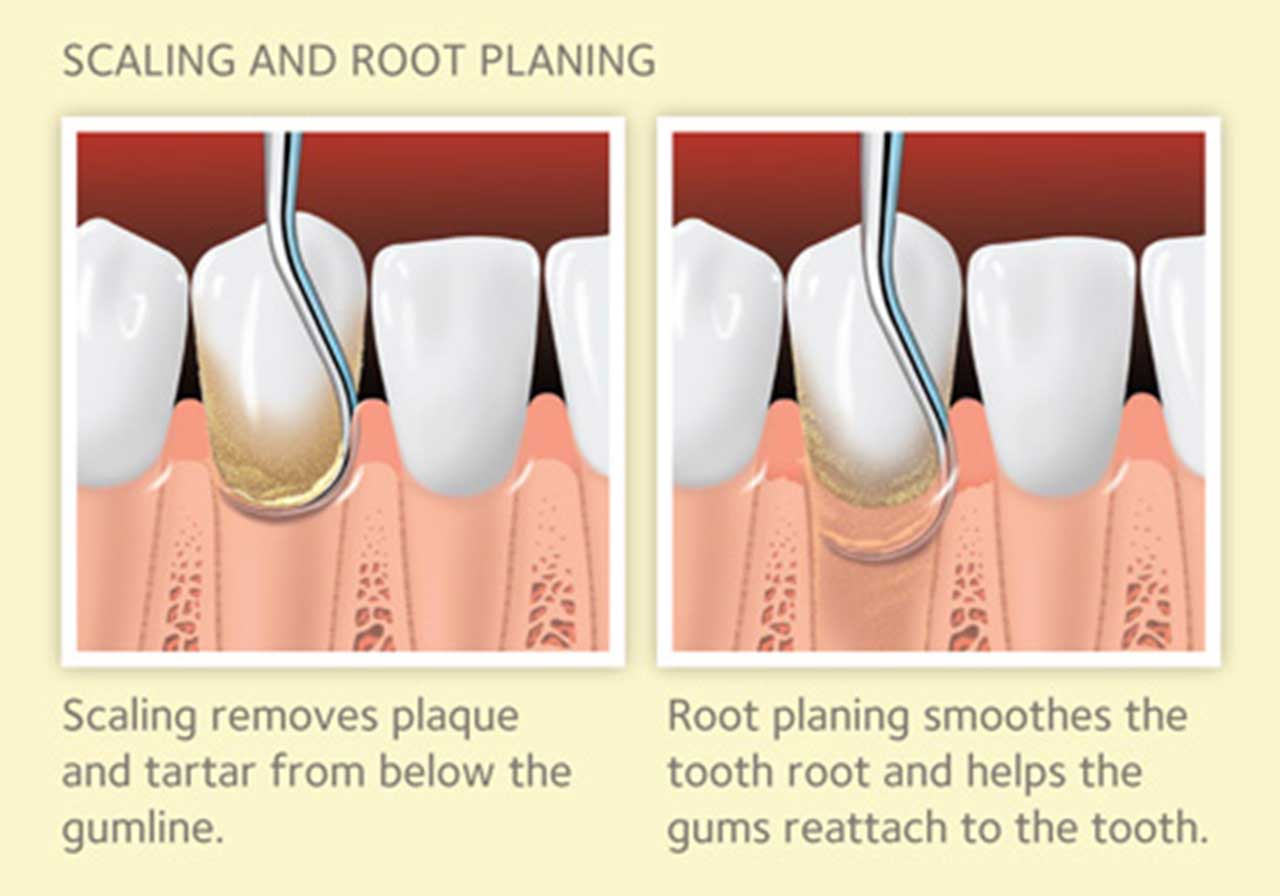 Tooth Scaling and Planing