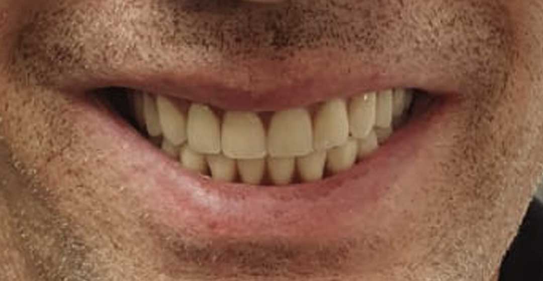 After dental implants