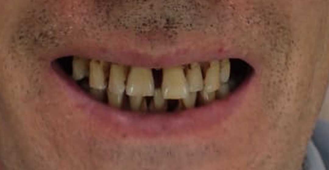 Before dental implants