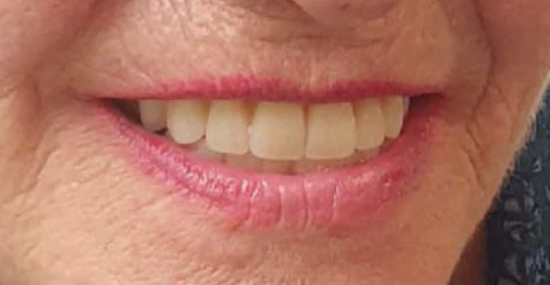 After dental implants