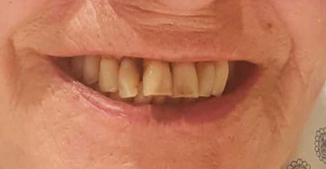 Before dental implants