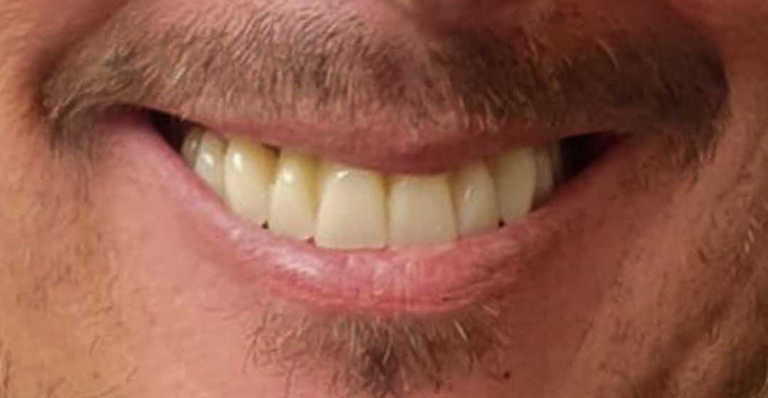 After dental implants