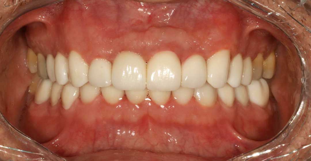 Porcelain Veneers